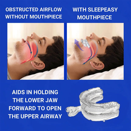 MIRORA Unisex Effective Snoring Solution & Reusable Snore Guard Anti-Snoring Mouthpiece